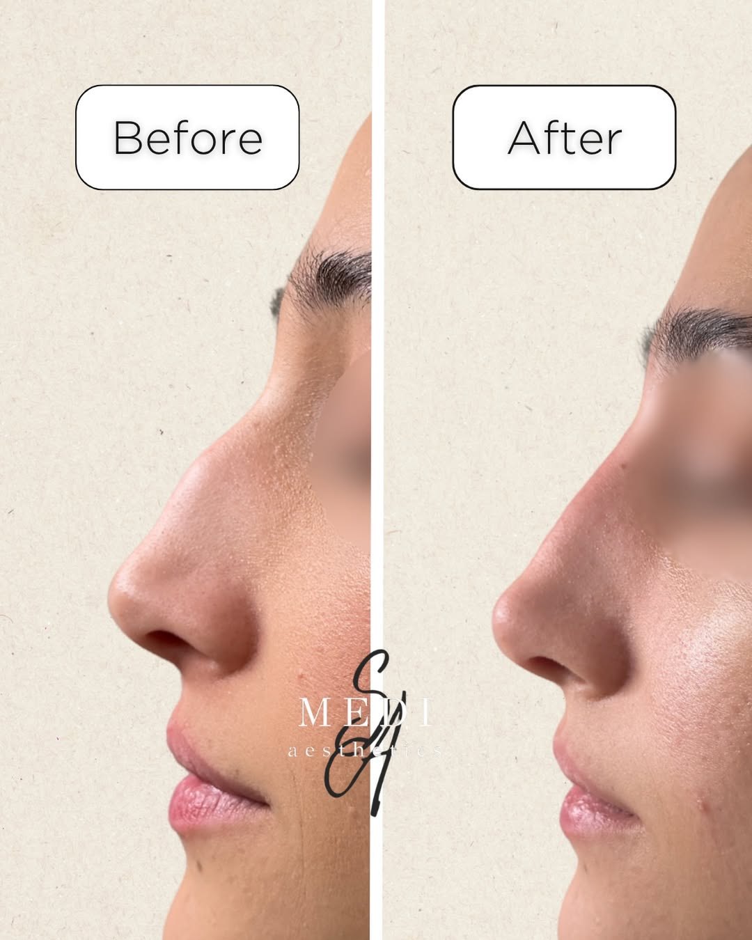 Before and after — non-surgical nose reshaping at Medi SA Aesthetics